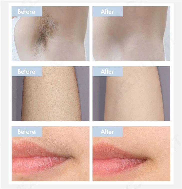 Upgrade Diode Laser Hair Removal